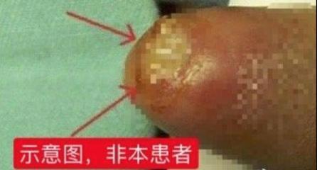 包皮垢是怎么回事