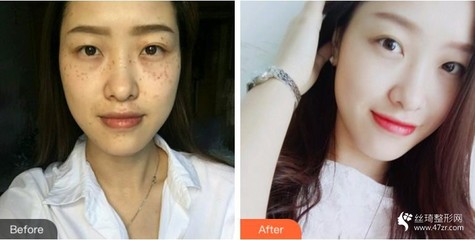 激光祛斑还有斑点