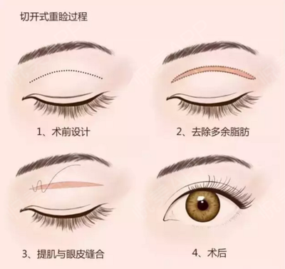 想做双眼皮