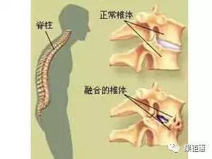 腰间狭窄是怎么回事