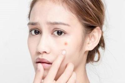 28了还长痘痘