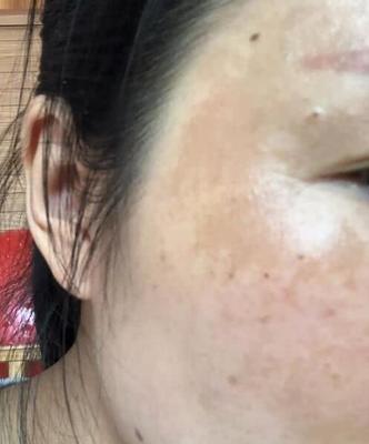 月经期间额头痘痘怎么办