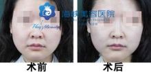 玻尿酸好吗