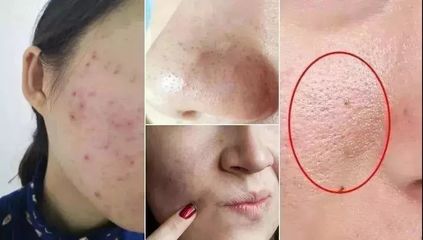用脏水洗脸会起痘痘吗