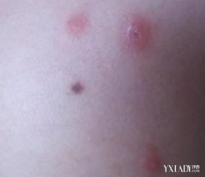 红痘痘怎么治