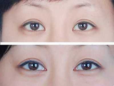 桃花眼必须是双眼皮吗