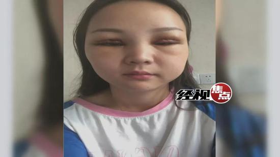 整容双眼皮的危害