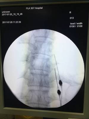 带状疱疹后遗神经痛怎么治疗