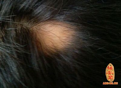 梦见自己头发掉了很多是什么意思