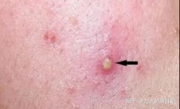 痘痘可以不处理嘛