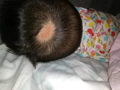 头上有疤痕怎么办