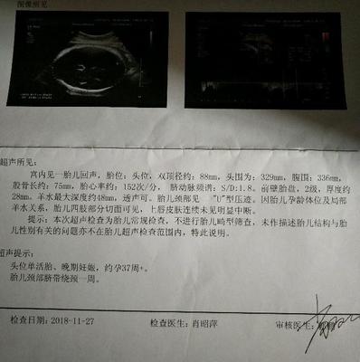胎儿绕颈三周