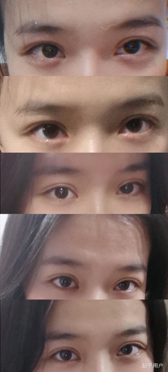 割双眼皮哭了怎么办