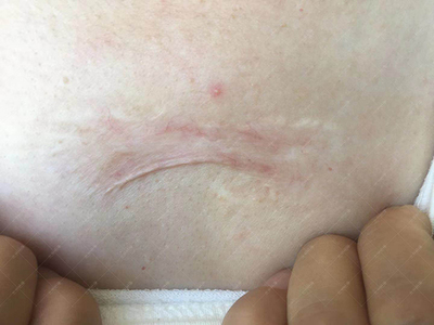 前胸长的痘痘会恢复吗