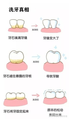 洗牙的步骤