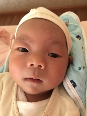 宝宝上眼睑下垂怎么办