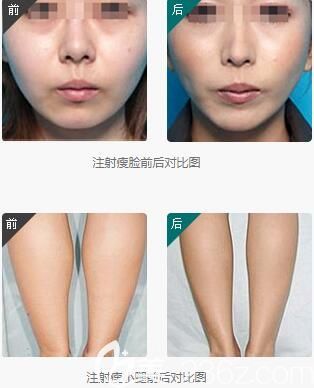 瘦脸针能瘦脸么
