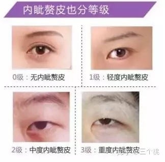 什么年龄双眼皮