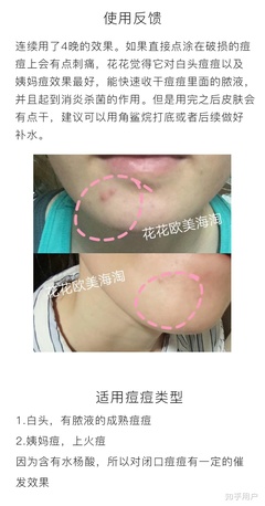 用痘痘贴是不是得挤破