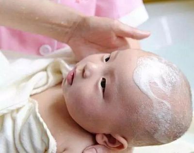 新生儿乳痂图片