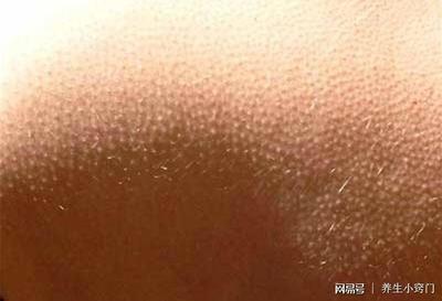 为什麽会起痘痘