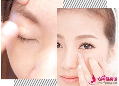 鼻头两侧痘痘怎么办