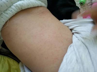宝宝退烧后起红疹图片