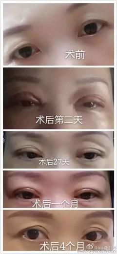 割完双眼皮想再开眼角