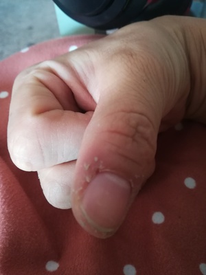 手指甲蜕皮是怎么回事