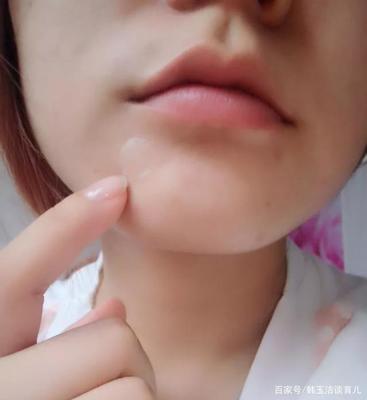同时爆十几个痘痘
