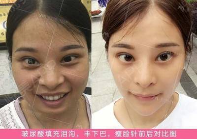 玻尿酸能去皱纹吗