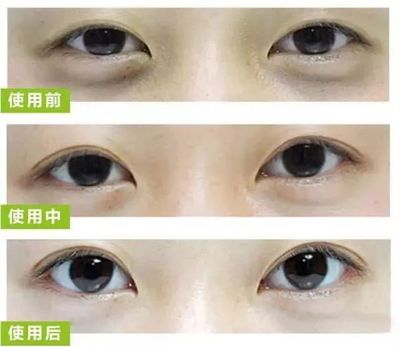 眼皮浮肿是怎么回事