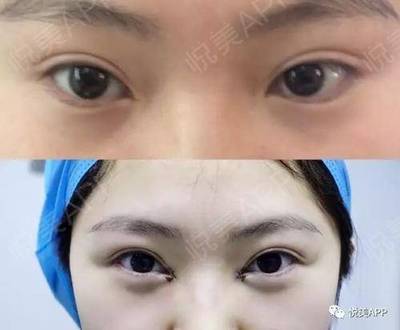 双眼皮修复失败