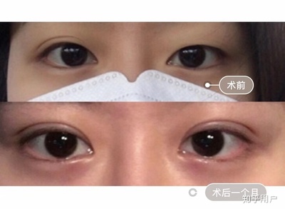 眼皮为什么一单一双
