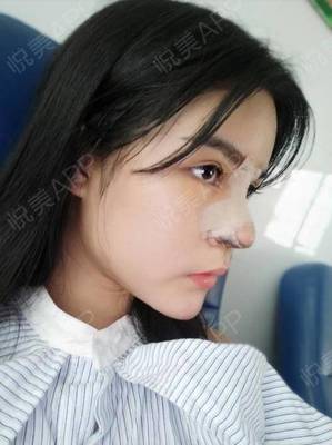 隆鼻7天后拆线疼不疼