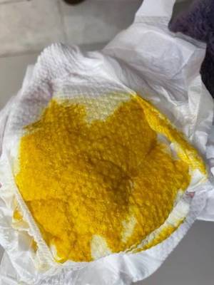 宝宝拉绿色稀便酸臭味