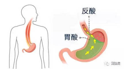 食道反酸是怎么回事