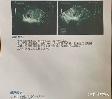 怀孕多久可见孕囊