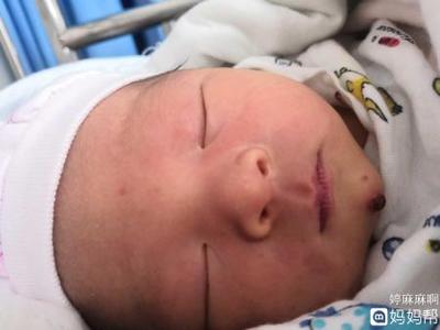 下巴老长大痘痘怎么回事