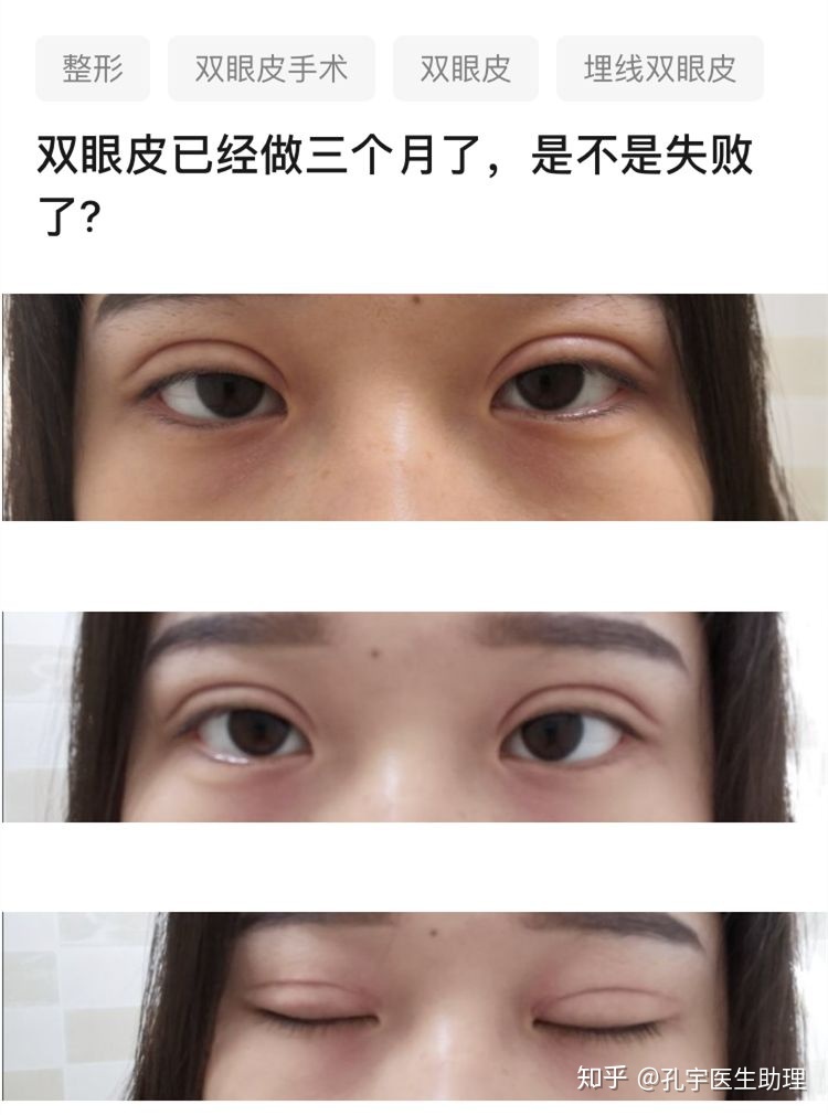 双眼皮哪种类型好看