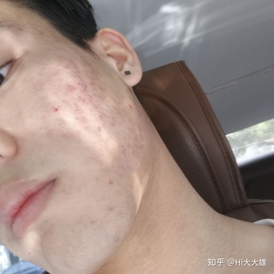 敷面膜的时候痘痘破了