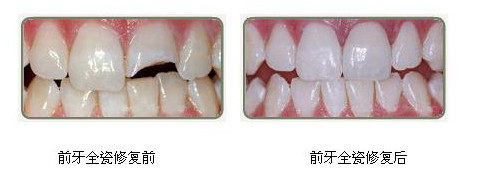 烤瓷牙哪一种好