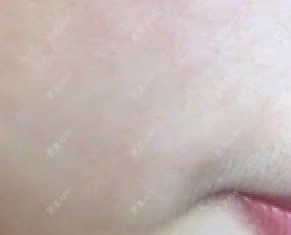 微针能不能去痘痘