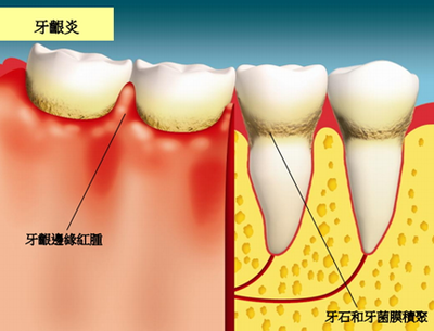 口腔出血是什么原因
