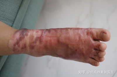 如何去除烫伤的疤痕