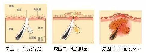 痘痘肌的四个成因