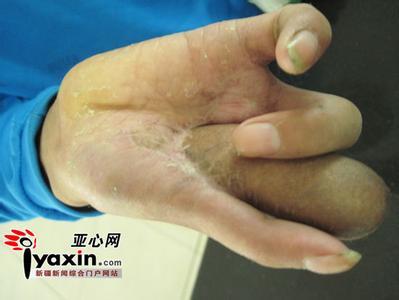 做梦梦到断手