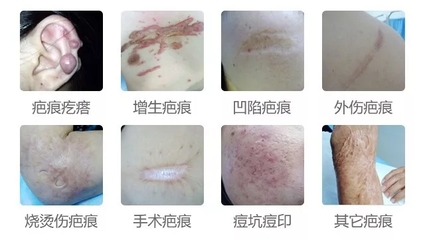 疤痕增生的症状