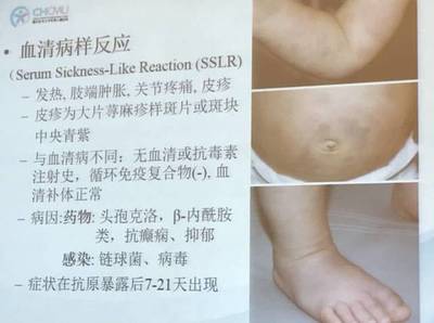 血清病怎么治疗