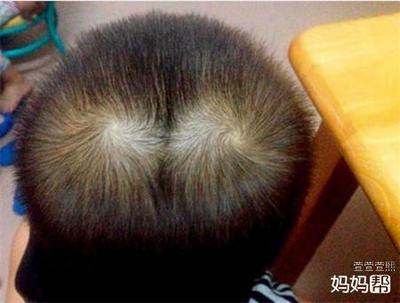 宝宝头顶旋偏右说法